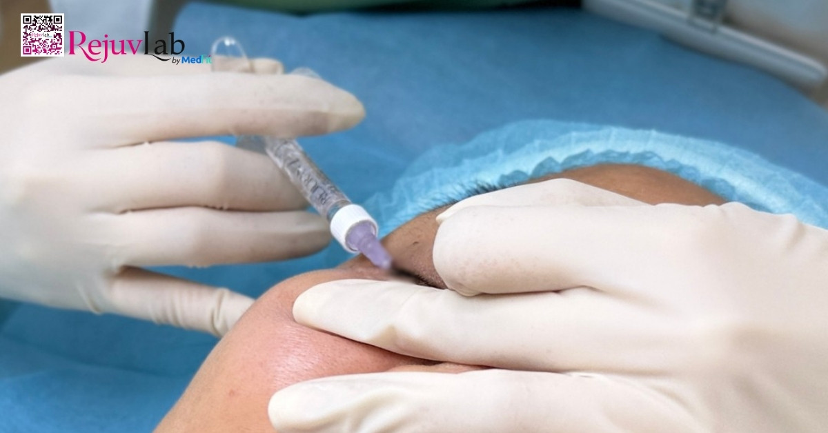 Tiêm meso vùng mắt: Giải pháp cải thiện quầng thâm và nếp nhăn li ti hiệu quả 2 Tiêm meso vùng mắt: Giải pháp cải thiện quầng thâm và nếp nhăn li ti hiệu quả 1