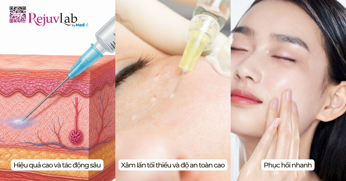 Tiêm meso vùng mắt: Giải pháp cải thiện quầng thâm và nếp nhăn li ti hiệu quả 6 Tiêm meso vùng mắt: Giải pháp cải thiện quầng thâm và nếp nhăn li ti hiệu quả 5