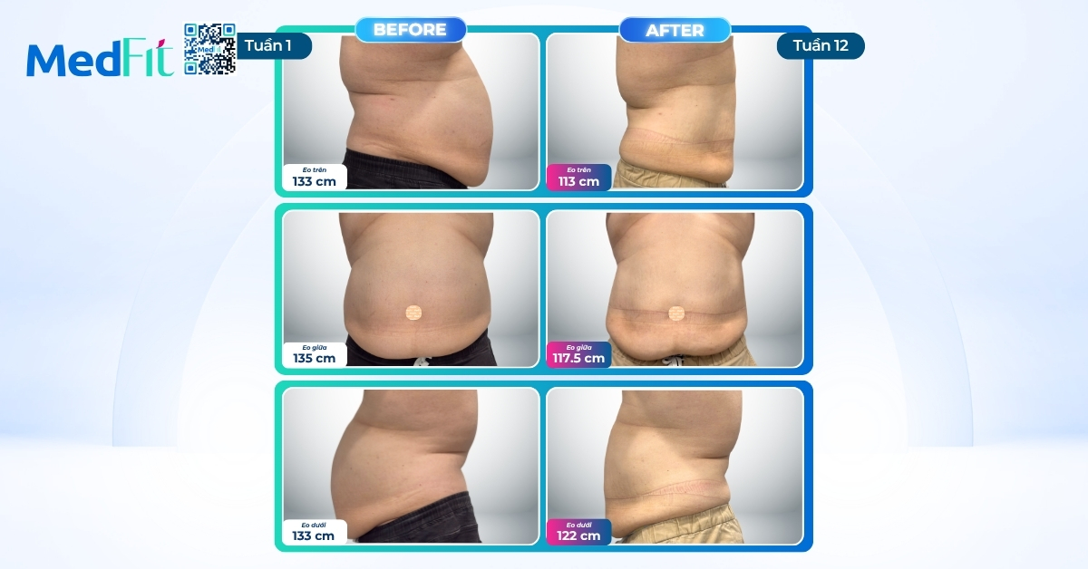 Hành trình giảm ngoạn mục 26,8kg và 48,5cm vòng eo chỉ sau 12 tuần của khách hàng 30+ tại MedFit 5