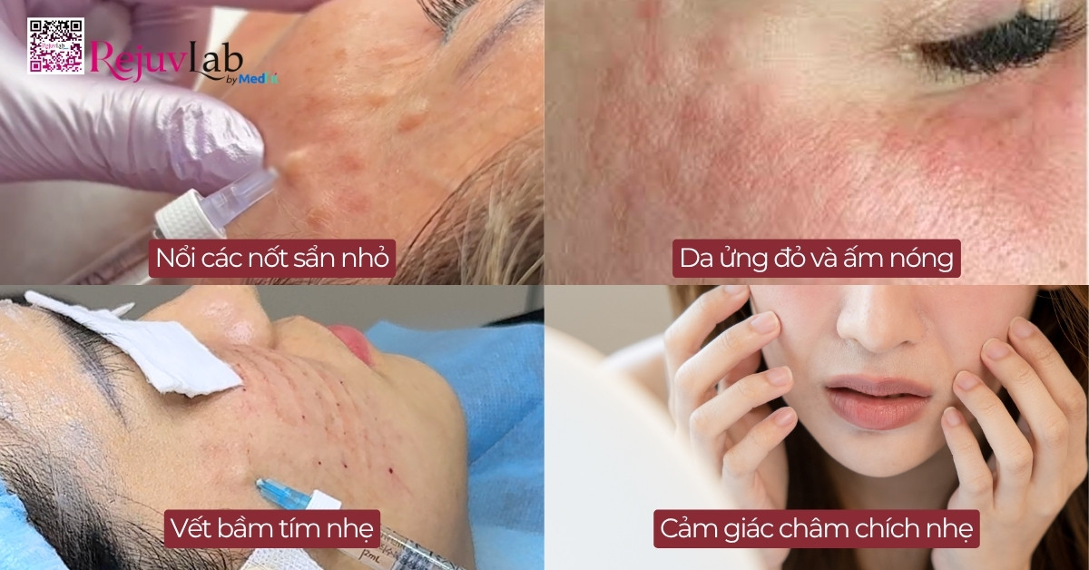 Tiêm meso bị sưng: Nguyên nhân, cách xử lý và phòng ngừa hiệu quả 5 Tiêm meso bị sưng: Nguyên nhân, cách xử lý và phòng ngừa hiệu quả 4
