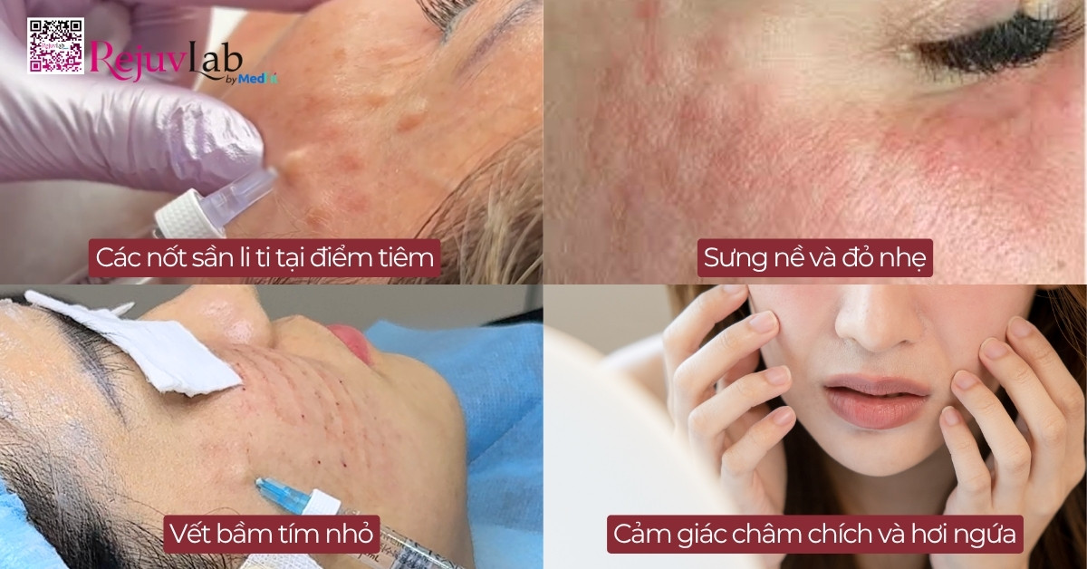 Tiêm meso bị ngứa: Khi nào là bình thường, khi nào là báo động đỏ? 8 Tiêm meso bị ngứa: Khi nào là bình thường, khi nào là báo động đỏ? 7