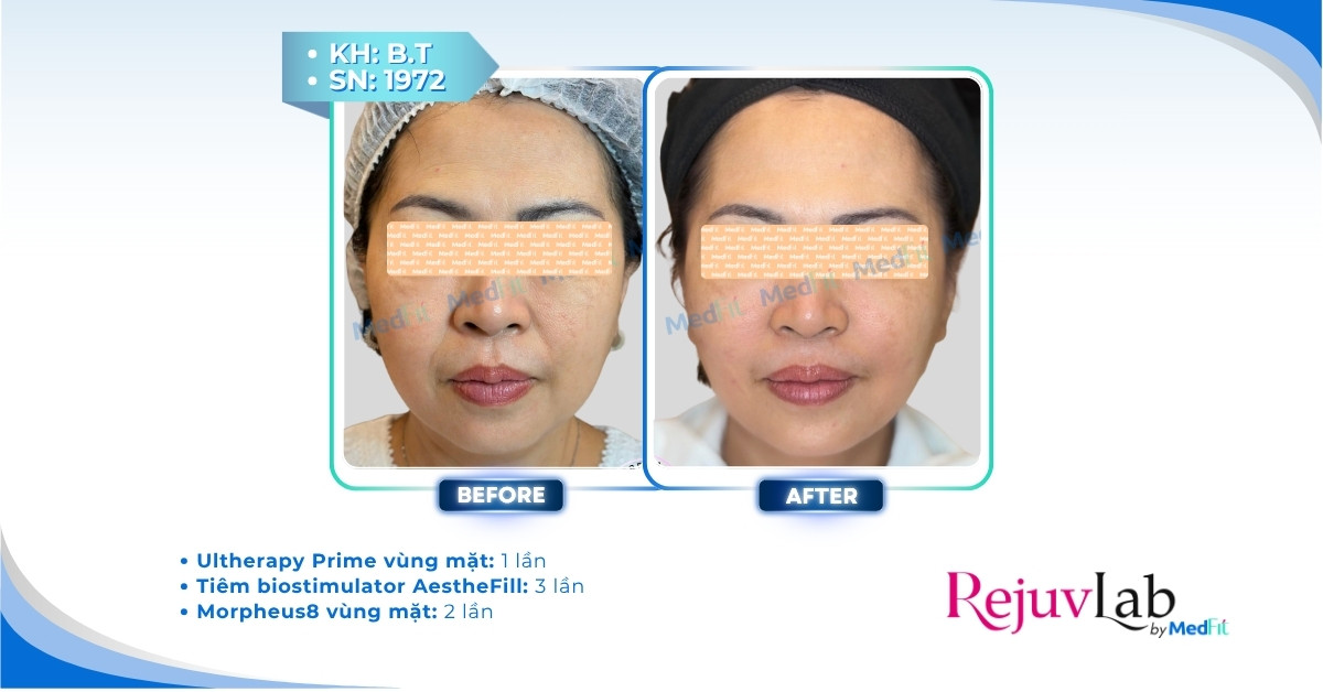 Trẻ hóa da với PLLA hoặc PDLLA, nên lựa chọn sản phẩm như thế nào? 14 Trẻ hóa da với PLLA hoặc PDLLA, nên lựa chọn sản phẩm như thế nào? 13