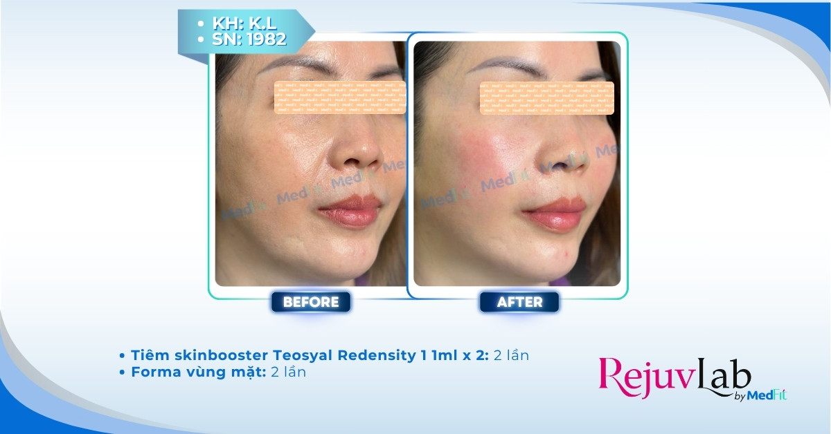 Review tác dụng của mesotherapy trong trẻ hóa da và điều trị sắc tố 7 Review tác dụng của mesotherapy trong trẻ hóa da và điều trị sắc tố 6