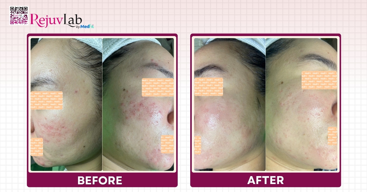 Review tiêm meso trị thâm mụn: Hiệu quả thực tế và chi phí trọn gói 5 Review tiêm meso trị thâm mụn: Hiệu quả thực tế và chi phí trọn gói 4