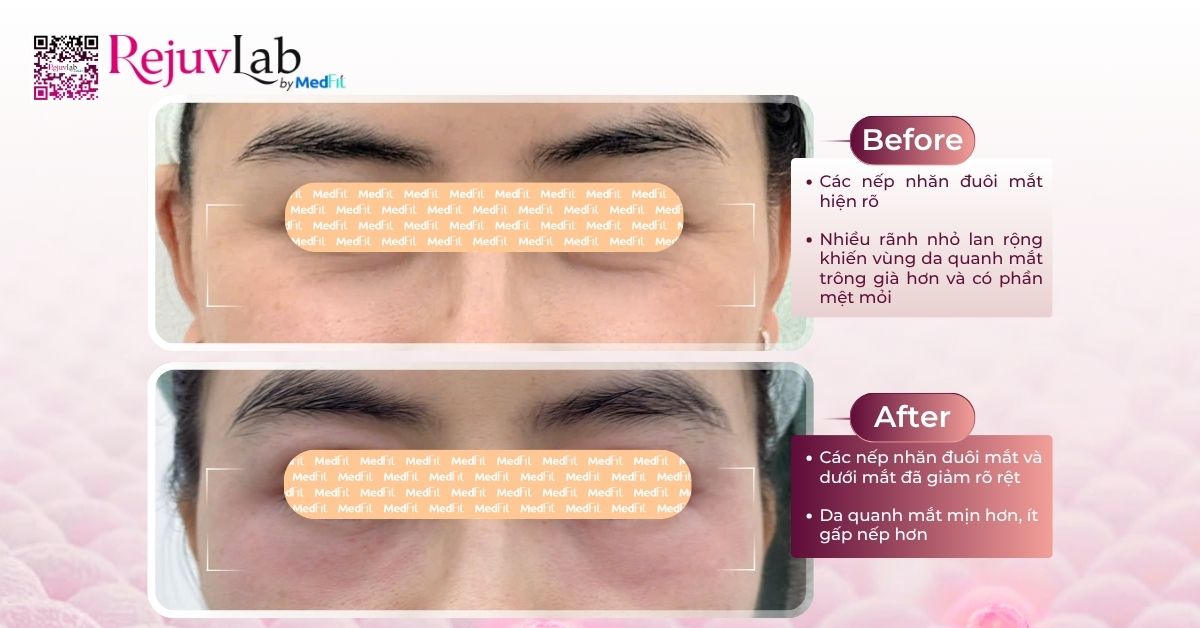 So sánh botox Hàn và Mỹ: Loại nào tốt và hiệu quả lâu dài hơn? 13 So sánh botox Hàn và Mỹ: Loại nào tốt và hiệu quả lâu dài hơn? 12