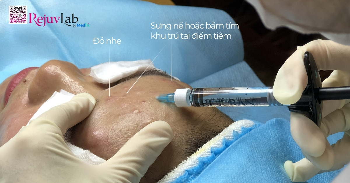 Tiêm meso bị sưng: Nguyên nhân, cách xử lý và phòng ngừa hiệu quả 2 Tiêm meso bị sưng: Nguyên nhân, cách xử lý và phòng ngừa hiệu quả 1