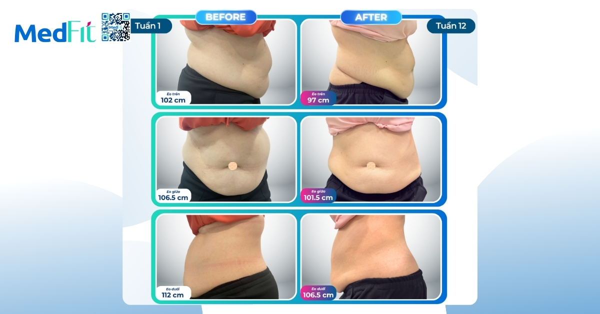 Đôi chân nặng nề không cản bước hành trình giảm cân, khách hàng giảm 9,4kg và 15,5cm vòng eo sau 12 tuần tại MedFit 7