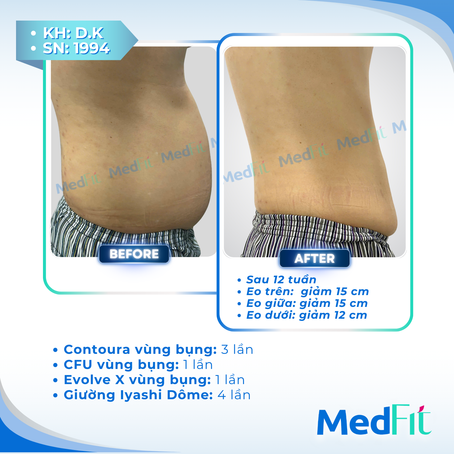 Giảm mỡ 2