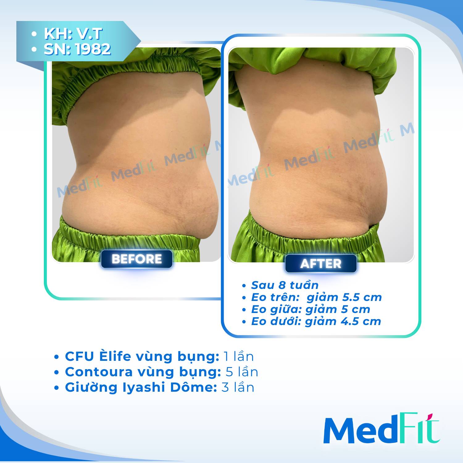 Giảm mỡ 5