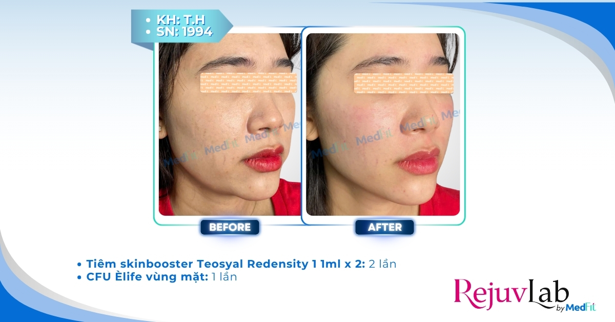 1cc filler giá bao nhiêu? Tổng hợp giá các loại filler phổ biến trên thị trường 31