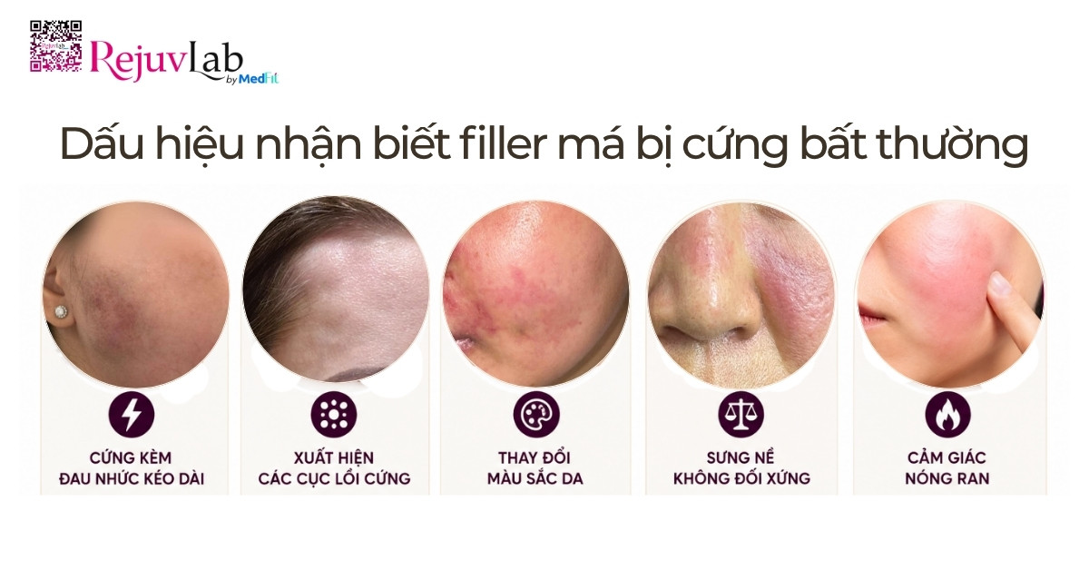 Tiêm filler má bao lâu thì mềm và vào form chuẩn nhất? Bí quyết chăm sóc da tại nhà sau khi tiêm filler 7 Tiêm filler má bao lâu thì mềm và vào form chuẩn nhất? Bí quyết chăm sóc da tại nhà sau khi tiêm filler 6