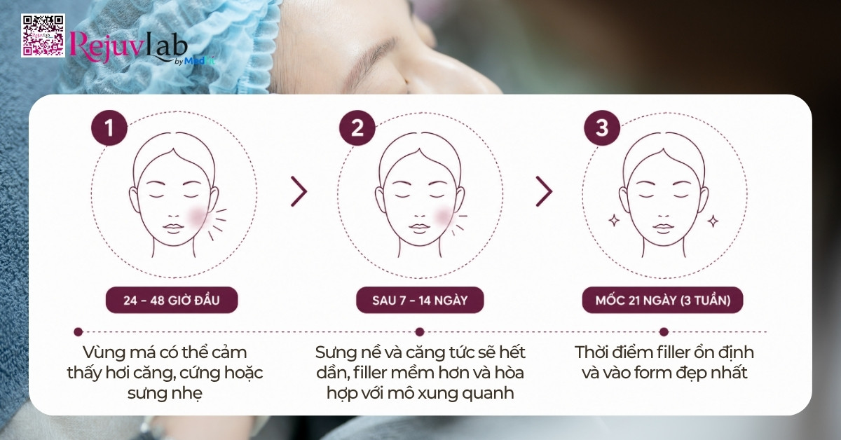 Tiêm filler má bao lâu thì mềm và vào form chuẩn nhất? Bí quyết chăm sóc da tại nhà sau khi tiêm filler 2 Tiêm filler má bao lâu thì mềm và vào form chuẩn nhất? Bí quyết chăm sóc da tại nhà sau khi tiêm filler 1