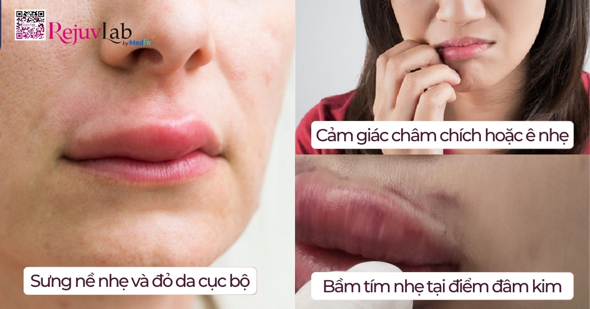 Tiêm tan filler có ảnh hưởng gì không? Khi nào nên tiêm? 4