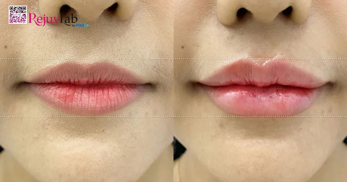 Tiêm filler môi giữ được bao lâu? Chi phí thế nào? 2 Tiêm filler môi giữ được bao lâu? Chi phí thế nào? 1