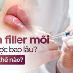 Tiêm filler môi giữ được bao lâu? Chi phí thế nào?