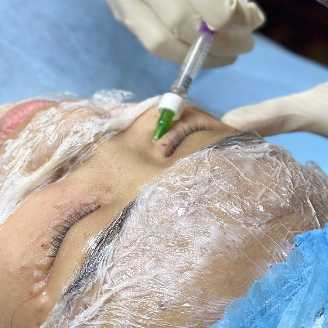 Tiêm Vitaran S vùng mắt