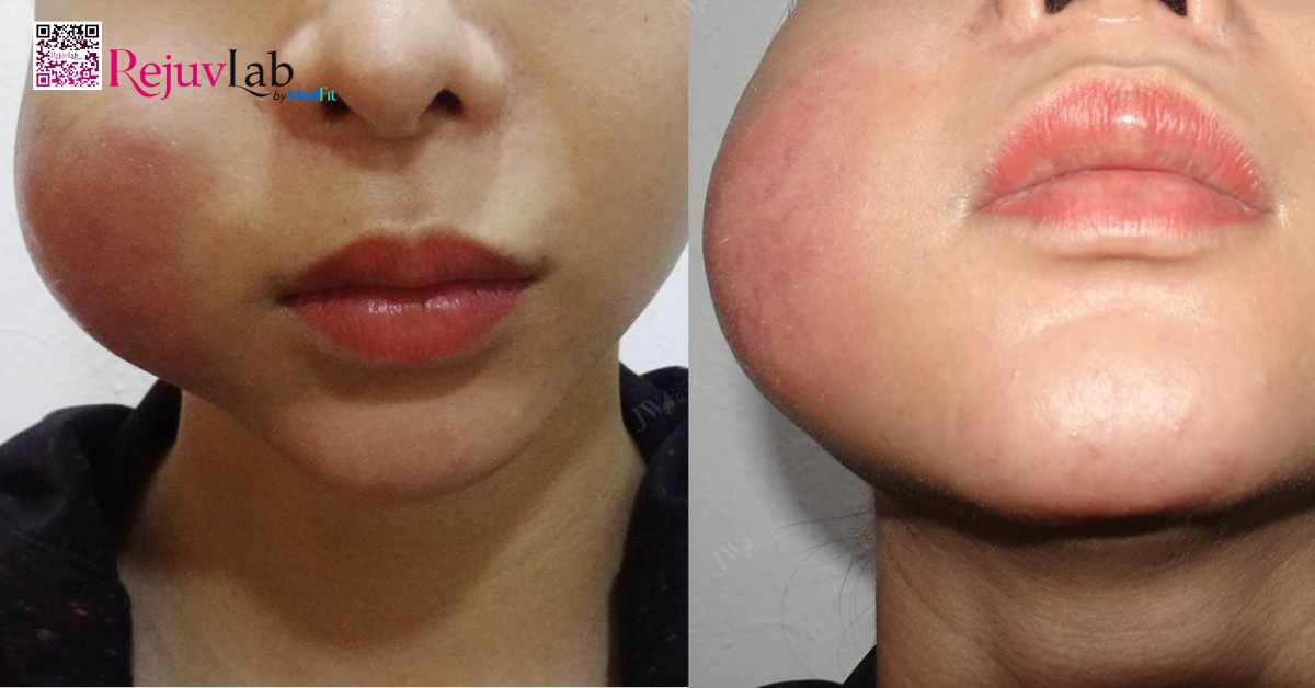 Tiêm filler má baby có hại không và những biến chứng đáng sợ cần biết 6