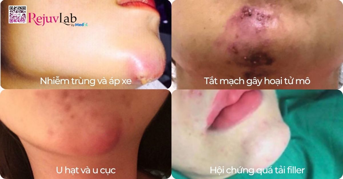 Tiêm filler độn cằm giá bao nhiêu và giữ được bao lâu? 8