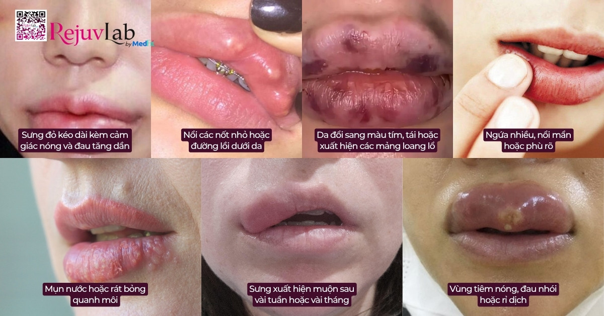 Tiêm filler môi có ảnh hưởng gì không? Những dấu hiệu nguy hiểm không được lờ đi 9
