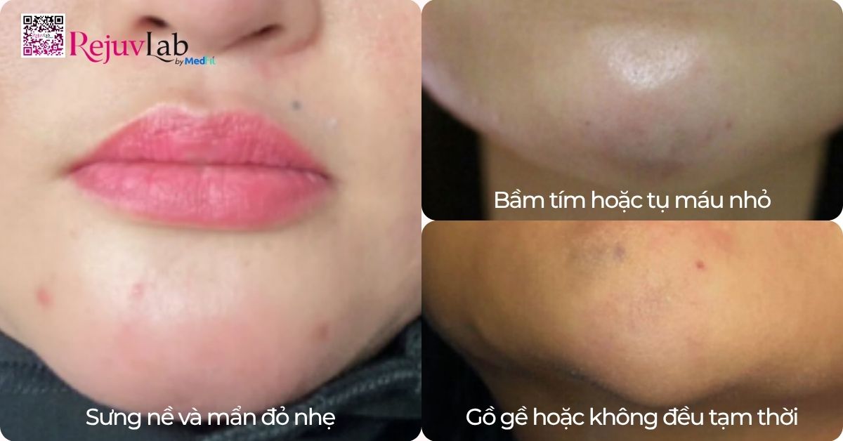 Tiêm filler độn cằm giá bao nhiêu và giữ được bao lâu? 6
