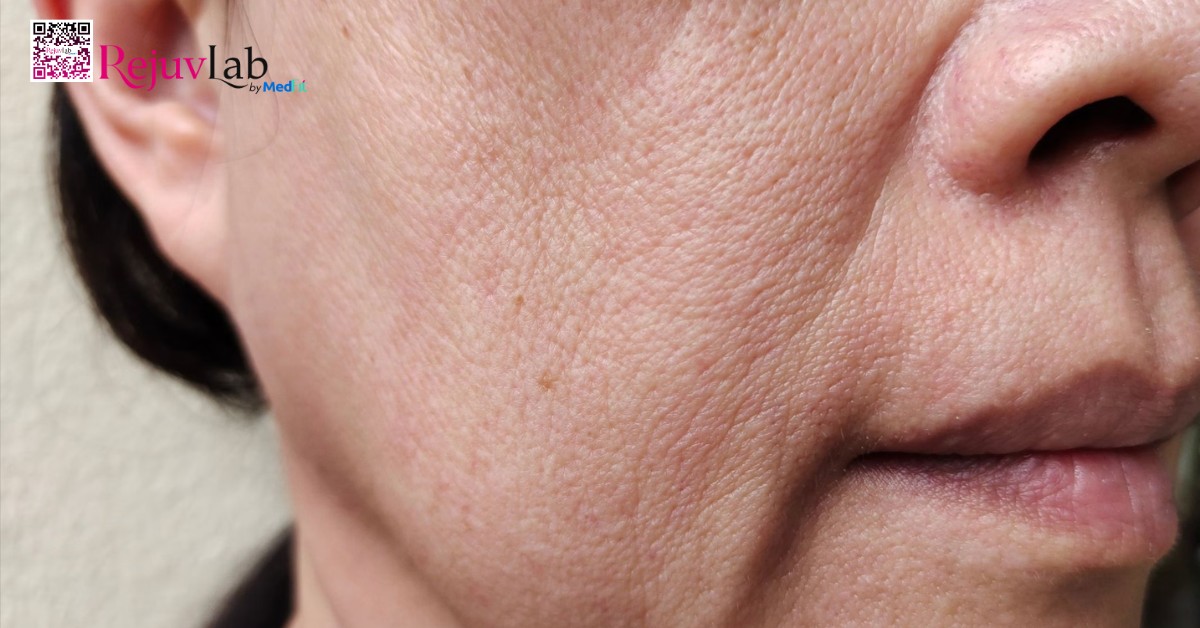 Tiêm filler má baby có hại không và những biến chứng đáng sợ cần biết 9