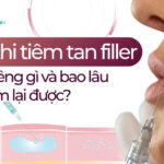 Sau khi tiêm tan filler cần kiêng gì và bao lâu thì tiêm lại được?