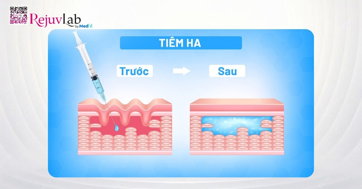Tiêm filler làm đầy hốc mắt có nguy hiểm không và những ai nên tránh? 1