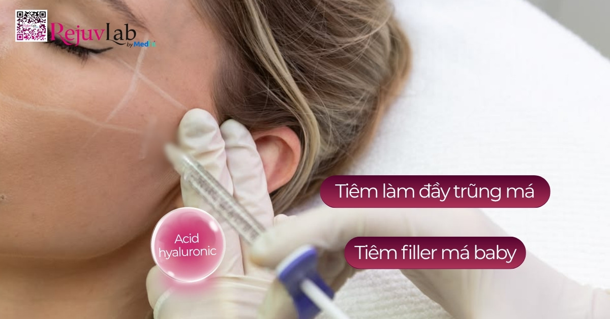 Tiêm filler má baby có hại không và những biến chứng đáng sợ cần biết 1