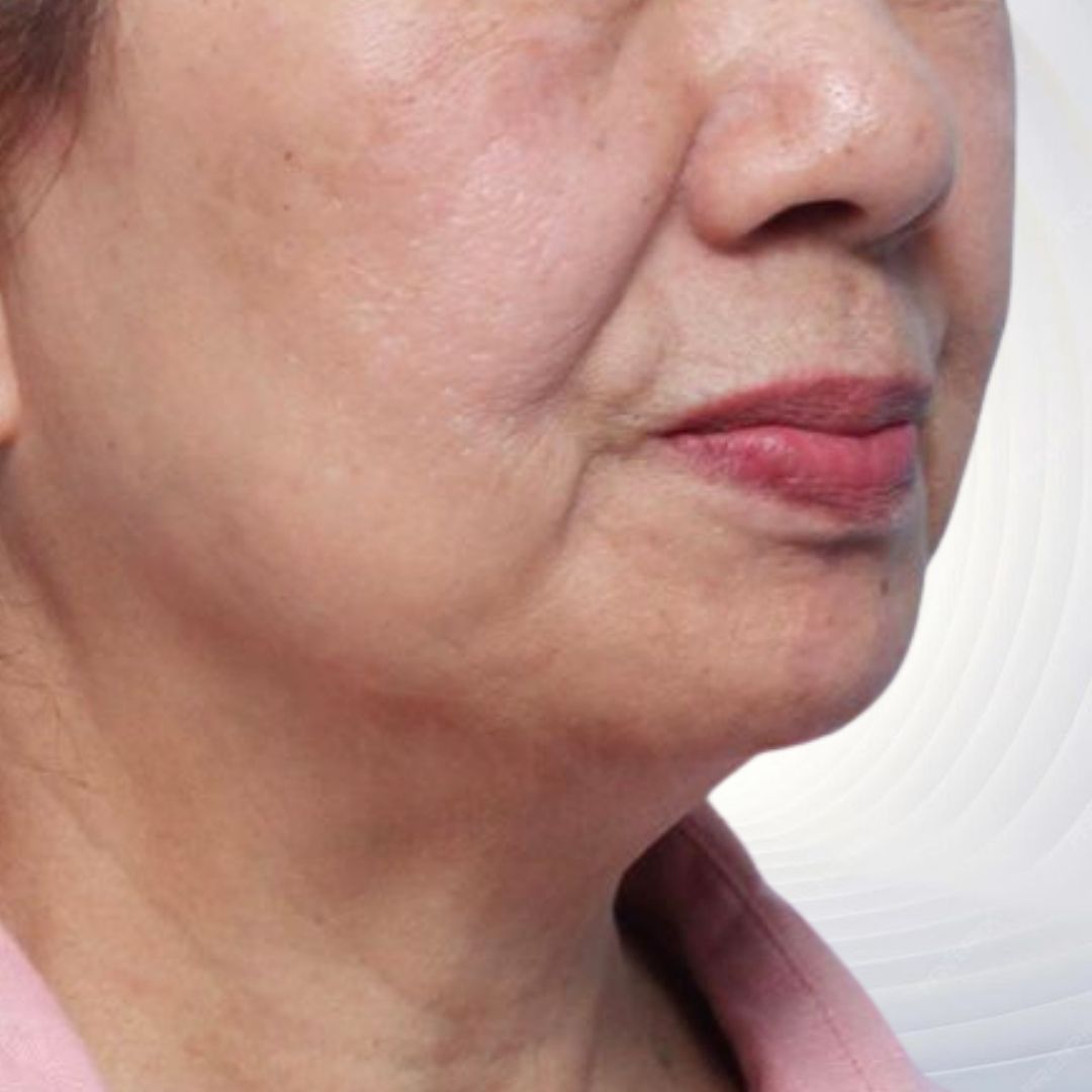 Vùng da chùng nhão, lỏng lẻo và chảy xệ