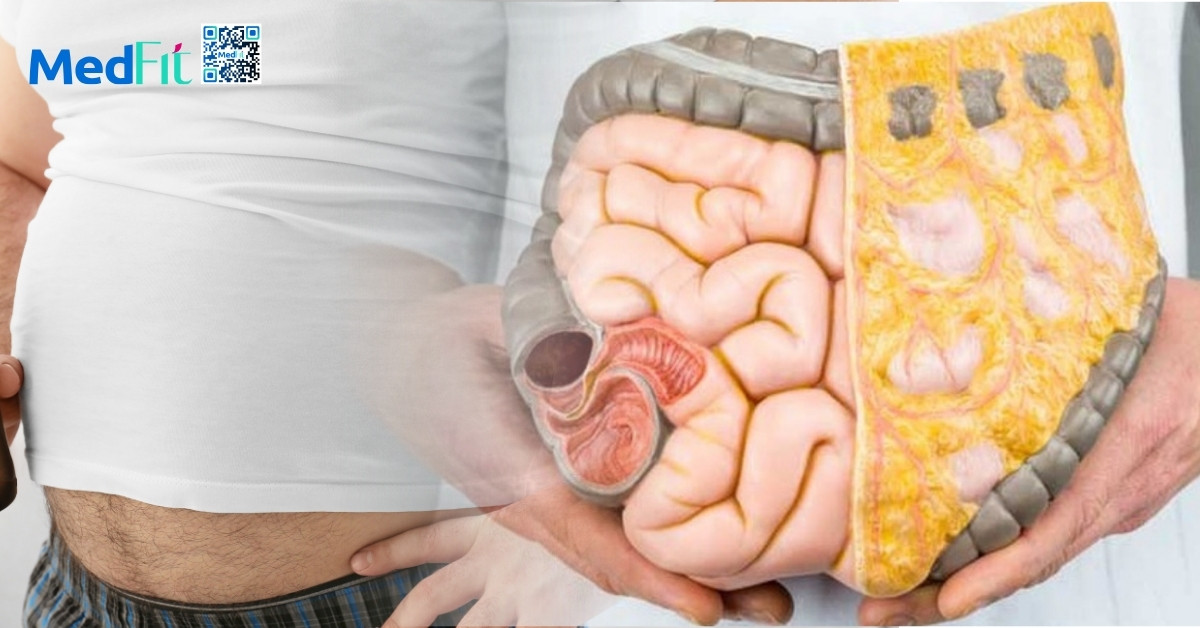 Hướng dẫn cách giảm bụng bia hiệu quả mà các quý ông không nên bỏ qua 1