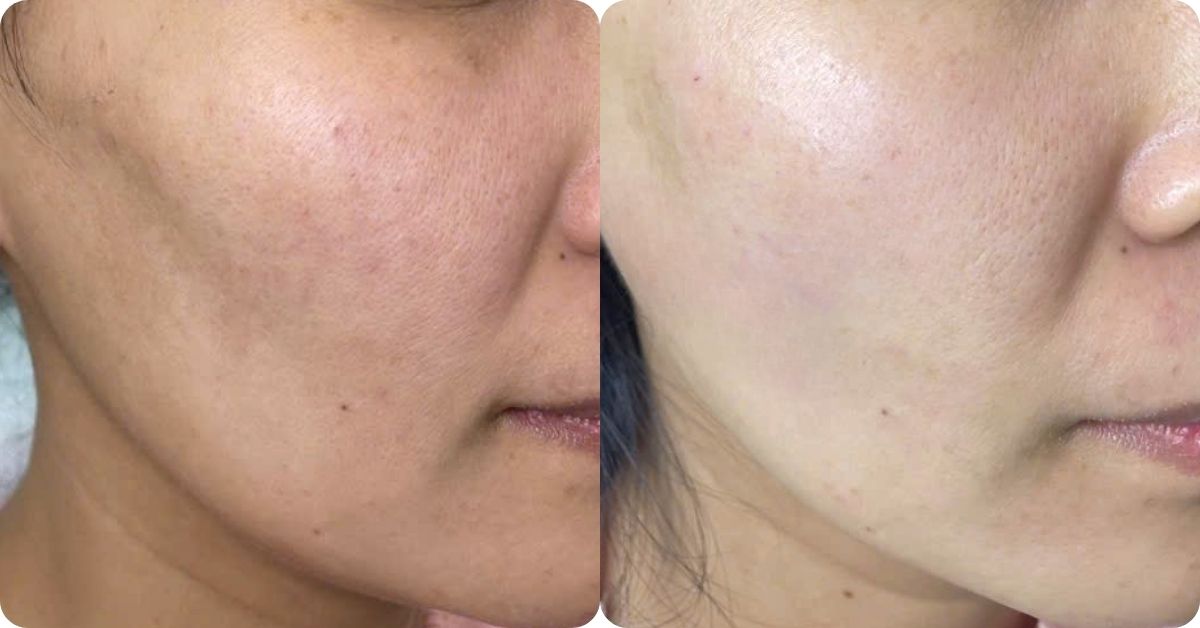 vùng hóp được làm đầy và nâng đỡ