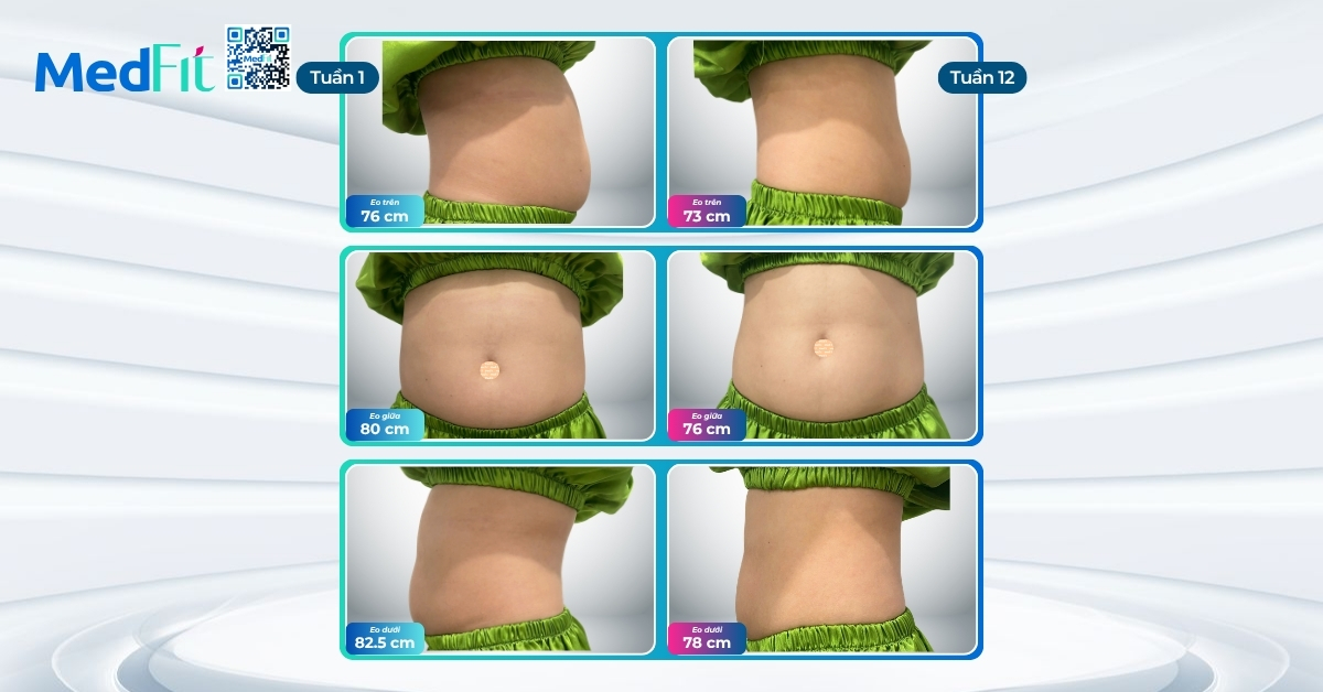 Từ ngưỡng thừa cân về BMI bình thường, khách hàng giảm gần 5kg và 11,5cm vòng eo sau 12 tuần tại MedFit 5