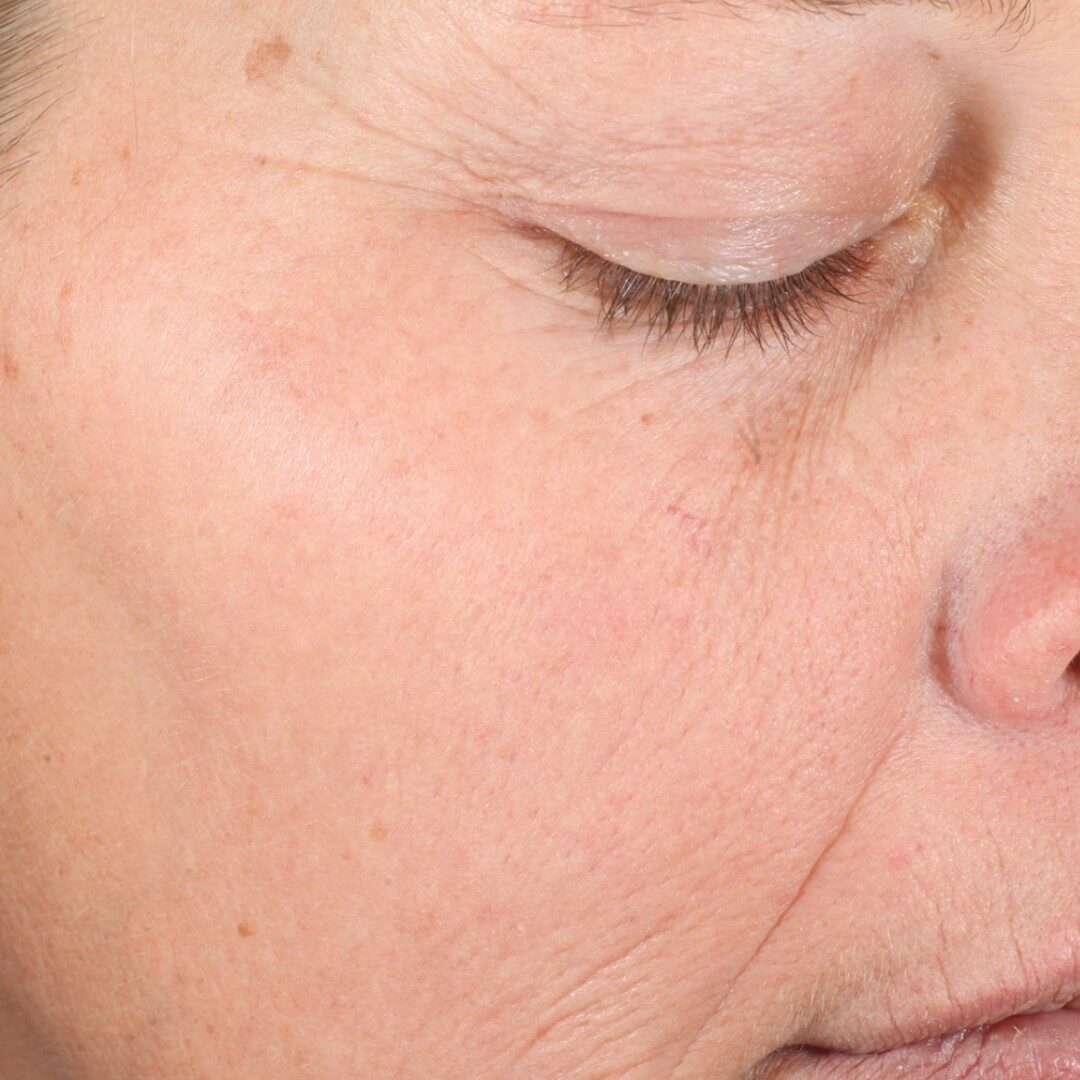 da chảy xệ, nhiều nếp nhăn