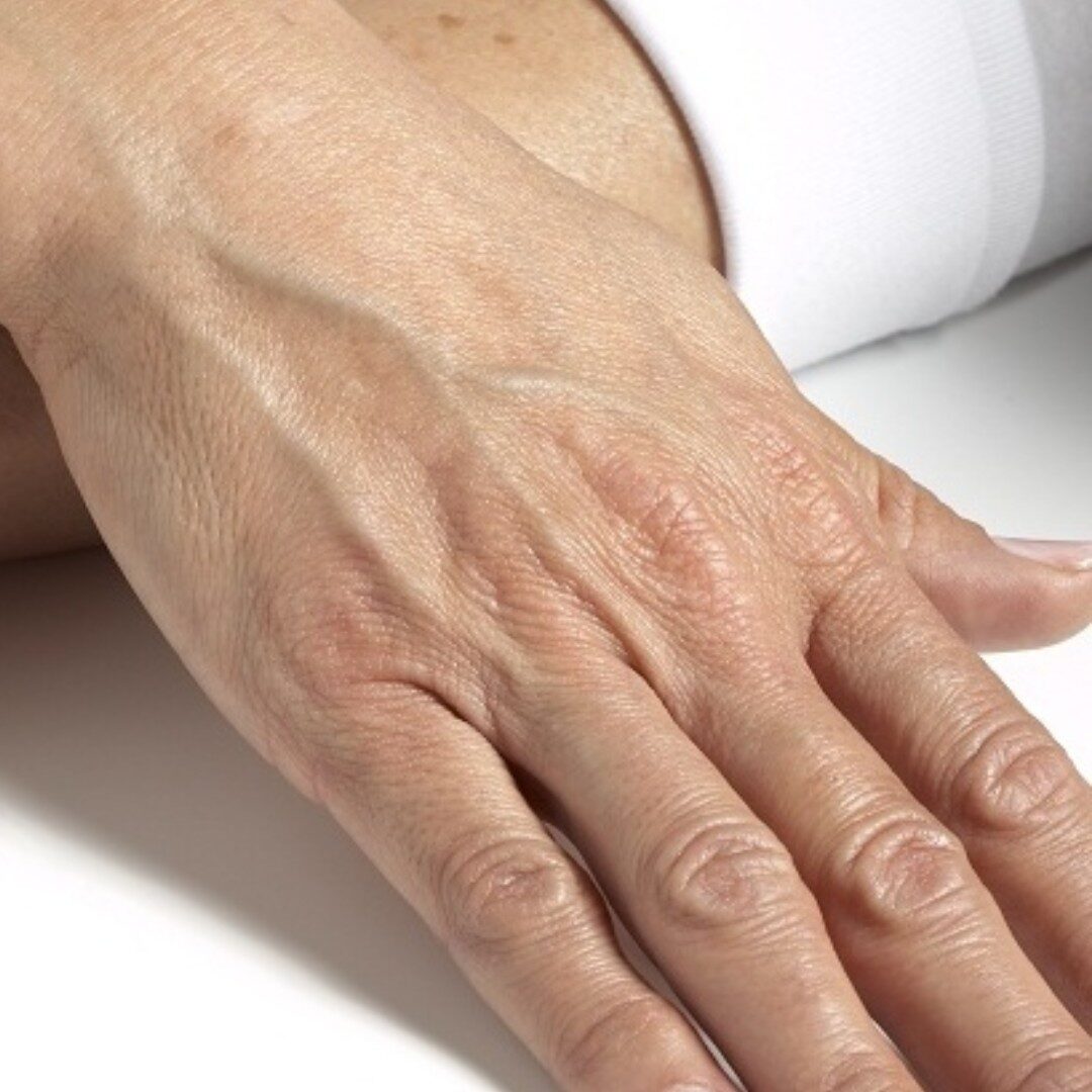 Da mỏng yếu nhăn nheo