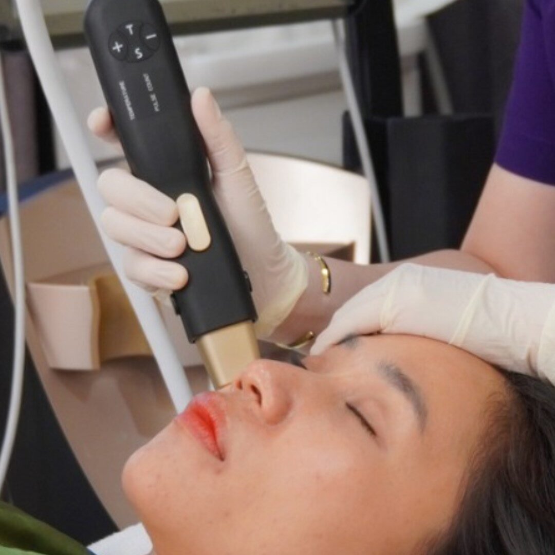 Density - Trẻ hóa vùng mắt