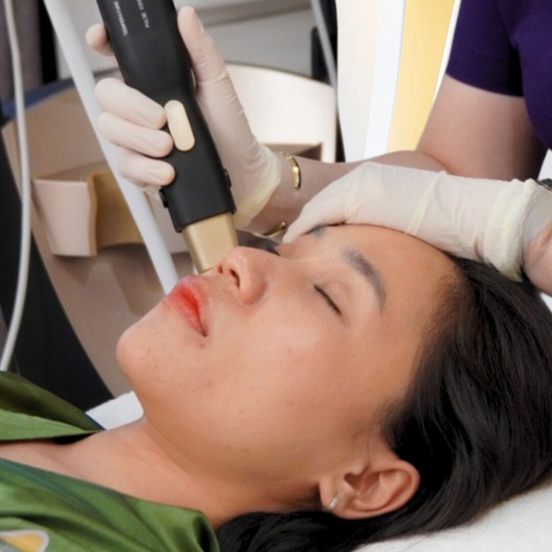 Không hợp với Hifu và muốn có trải nghiêm êm ái hơn