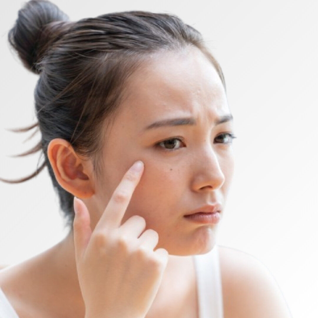 Làn da không đều màu
