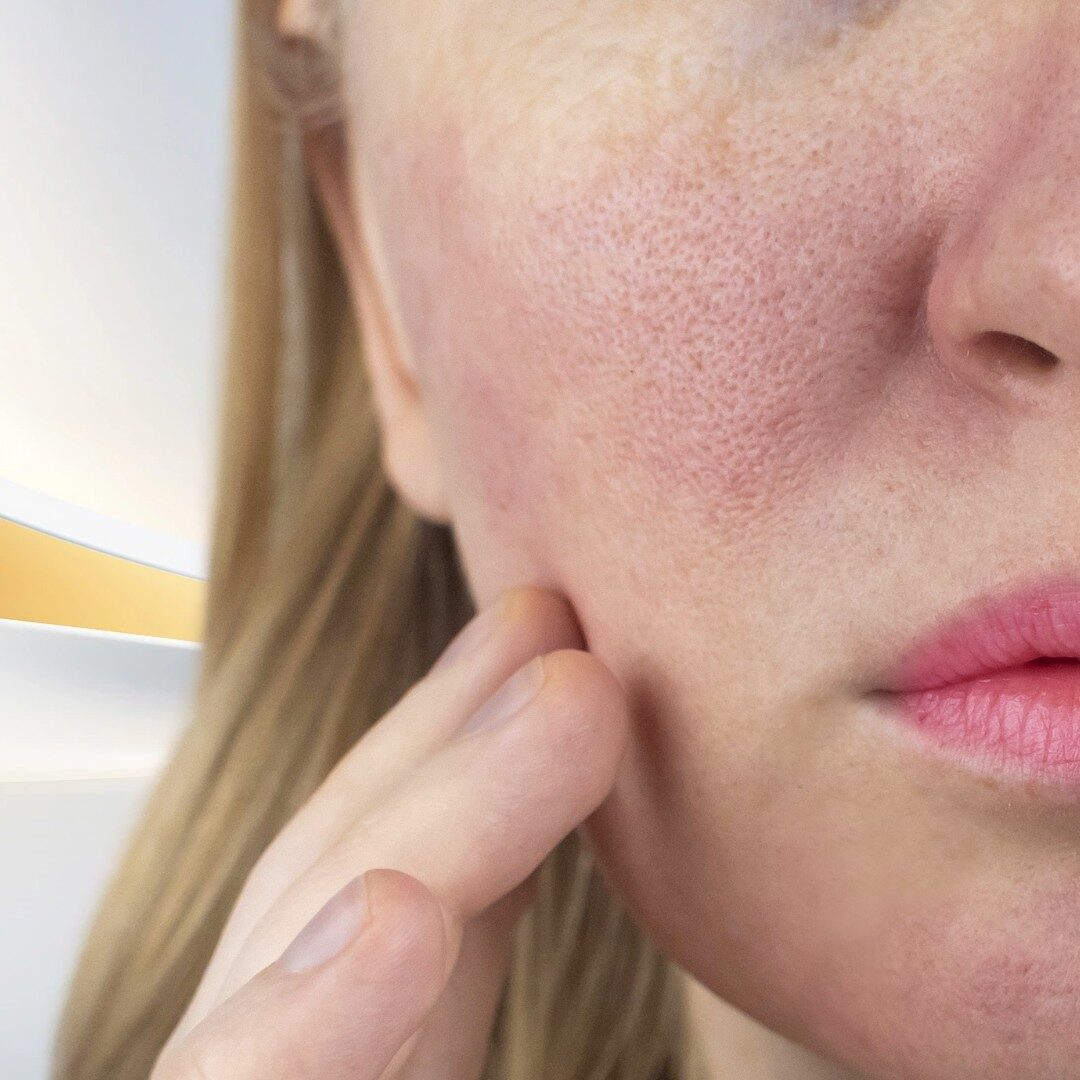 Làn da sần sùi, xỉn màu, lỗ chân lông giãn rộng