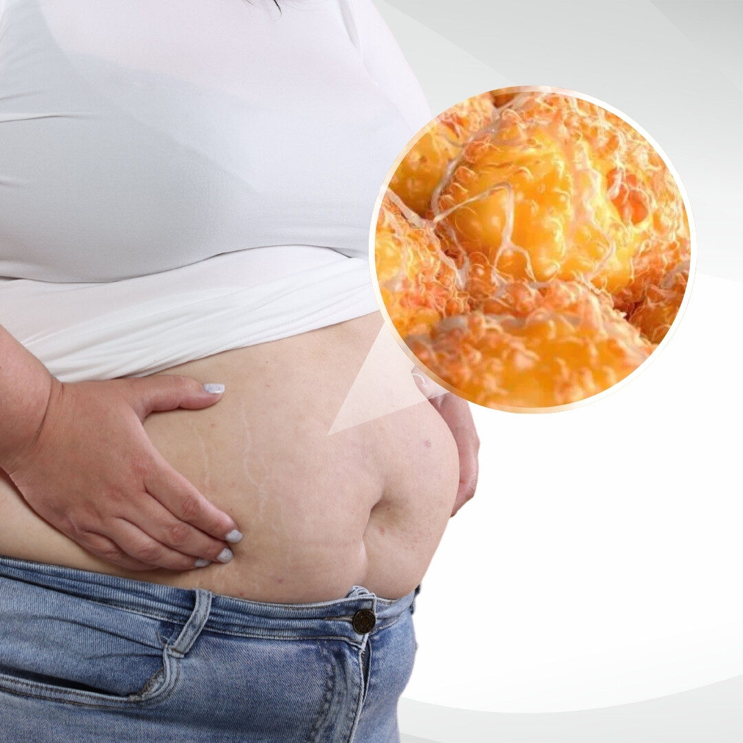 Mỡ thừa dưới da Mỡ thừa dưới da