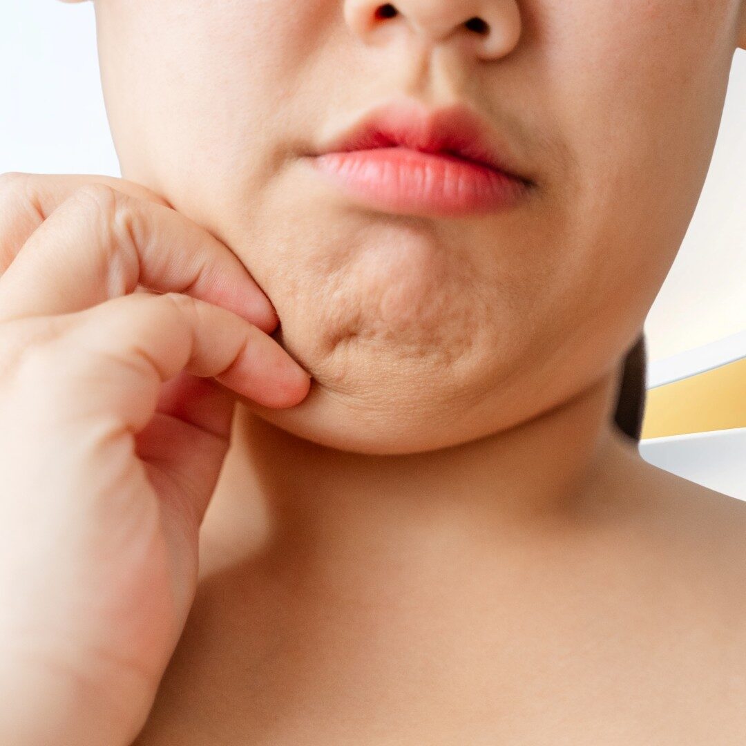 Mỡ thừa nọng cằm má dưới