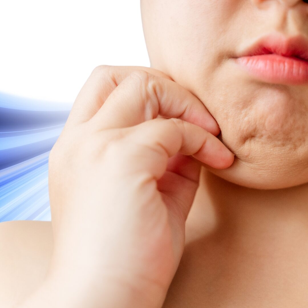 Mỡ thừa vùng mặt