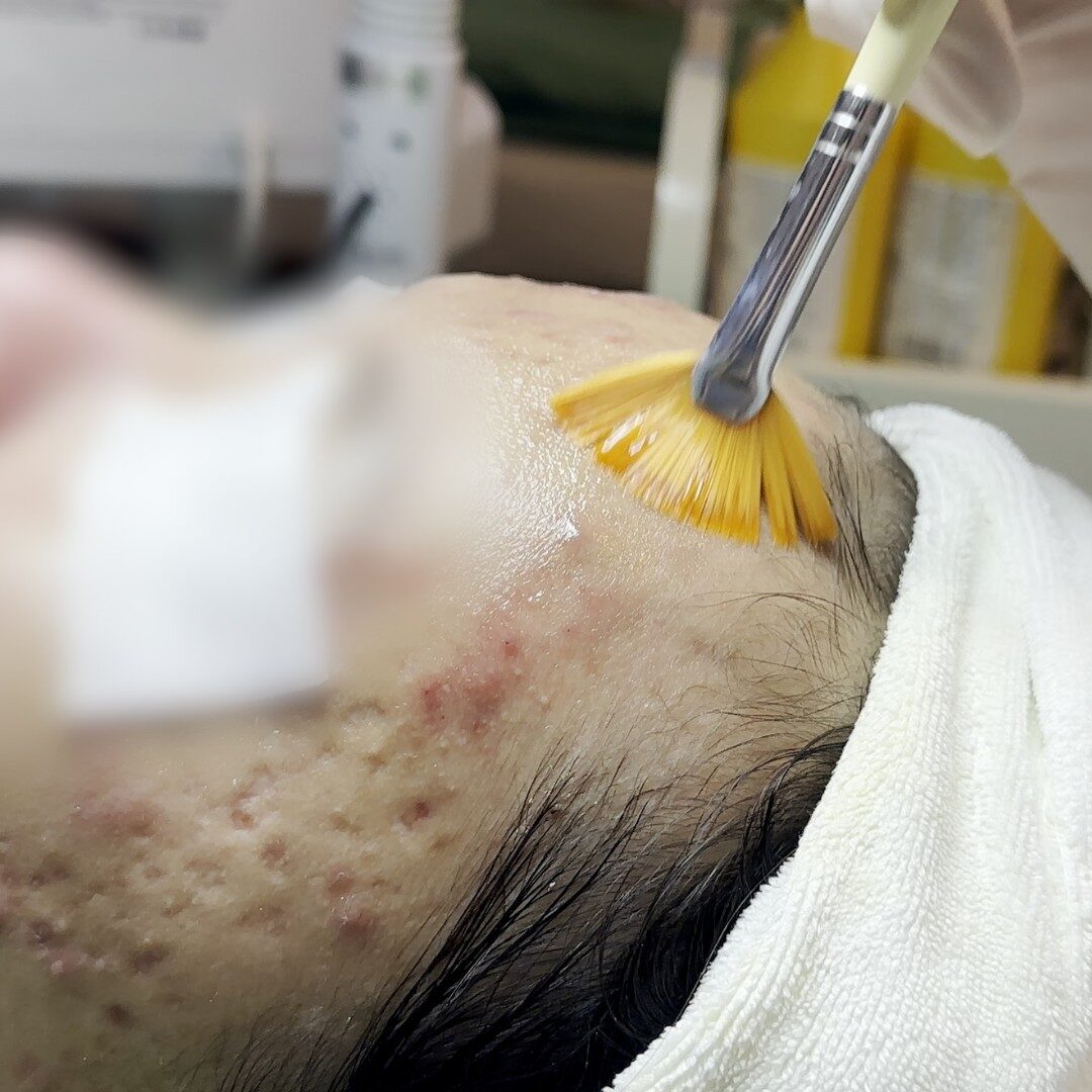 Peel da điều trị sẹo rỗ và sẹo sau mụn