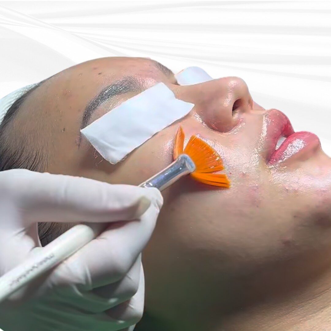 Peel da trẻ hóa RejuvLab