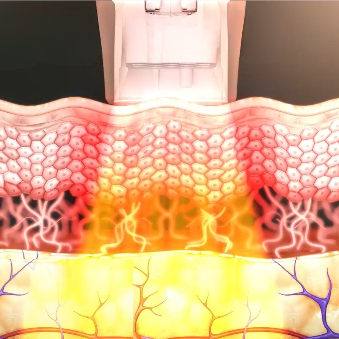 RF đơn cực - Monopolar
