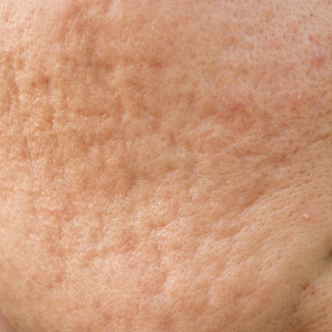 Sẹo lòng chảo - đáy tròn