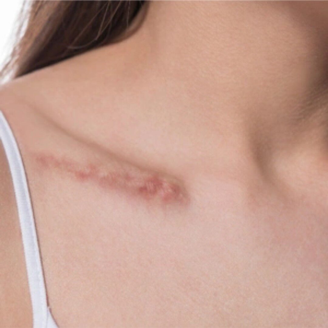 Sợi cơ kéo sẹo phì đại