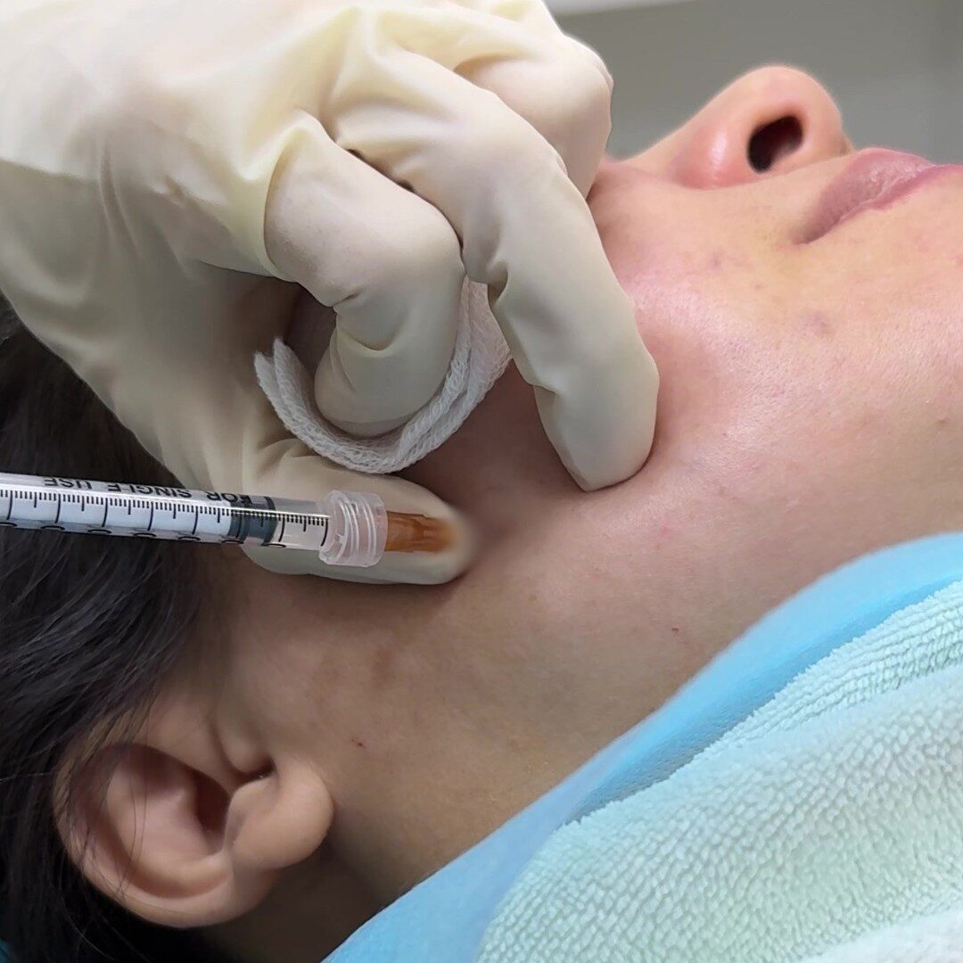 Tiêm botulinum toxin (Botox)
