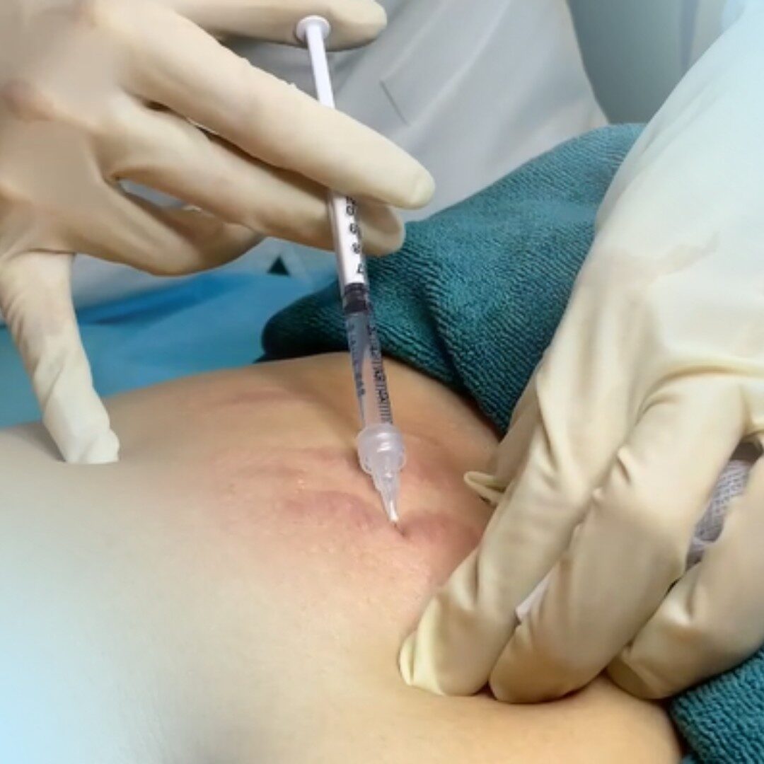 Tiêm meso trị rạn