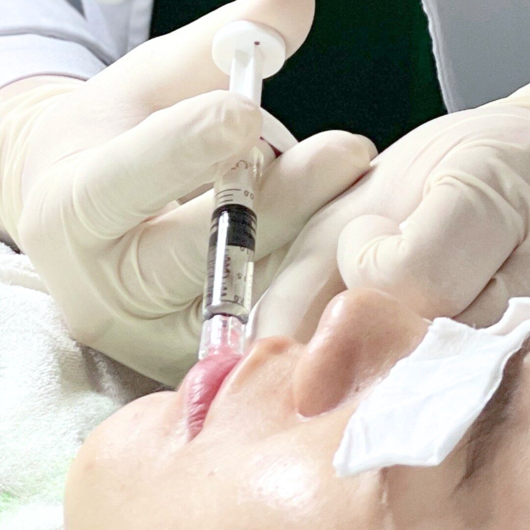 Tiêm skinbooster