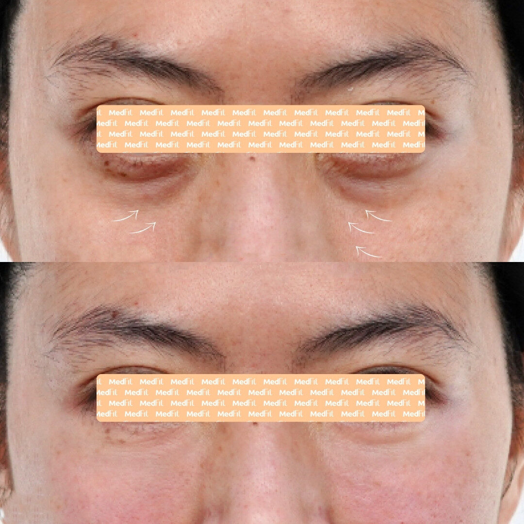 Trẻ hóa vùng mắt